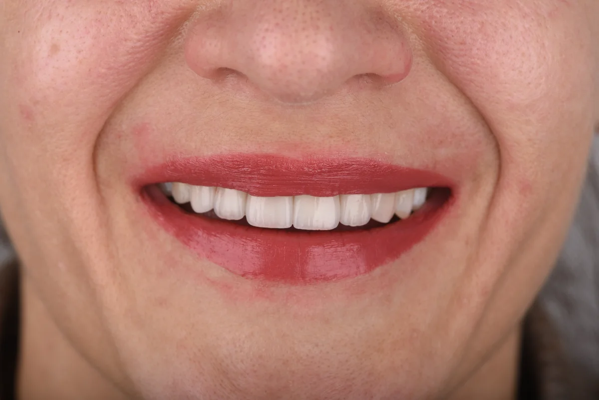 After — Veneers