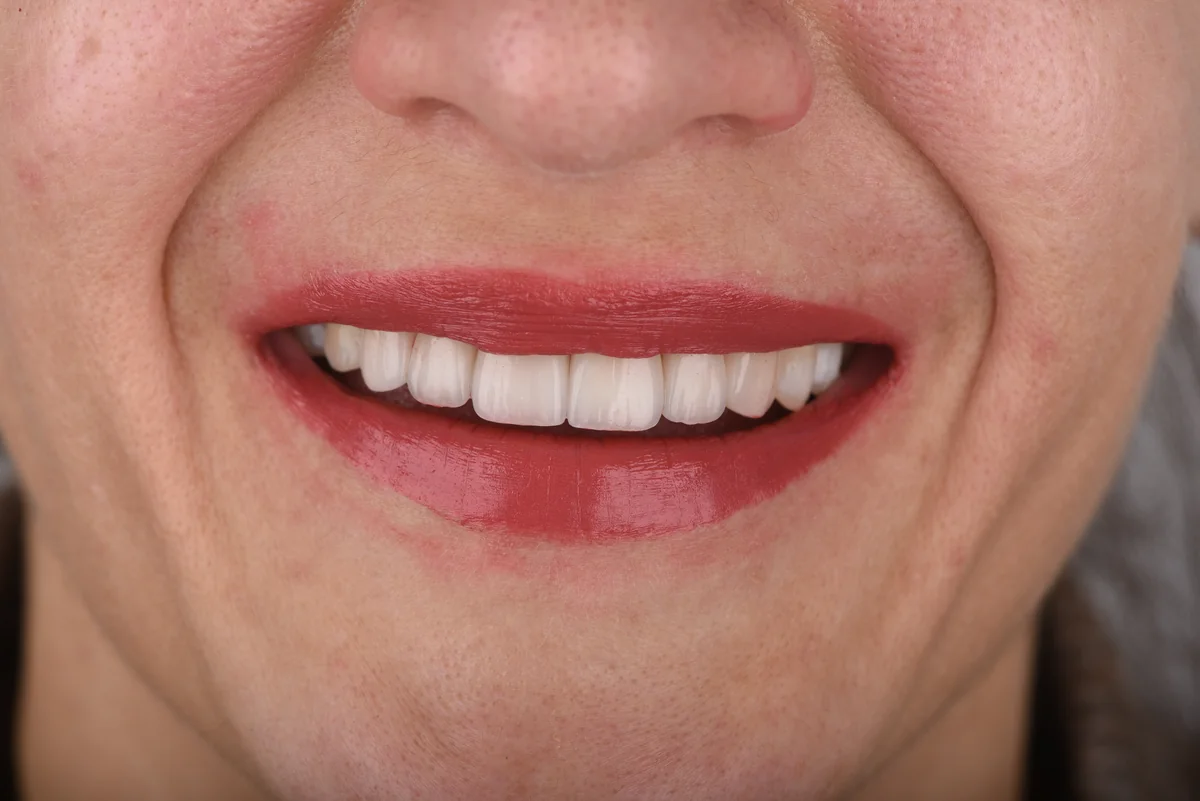 After — Veneers