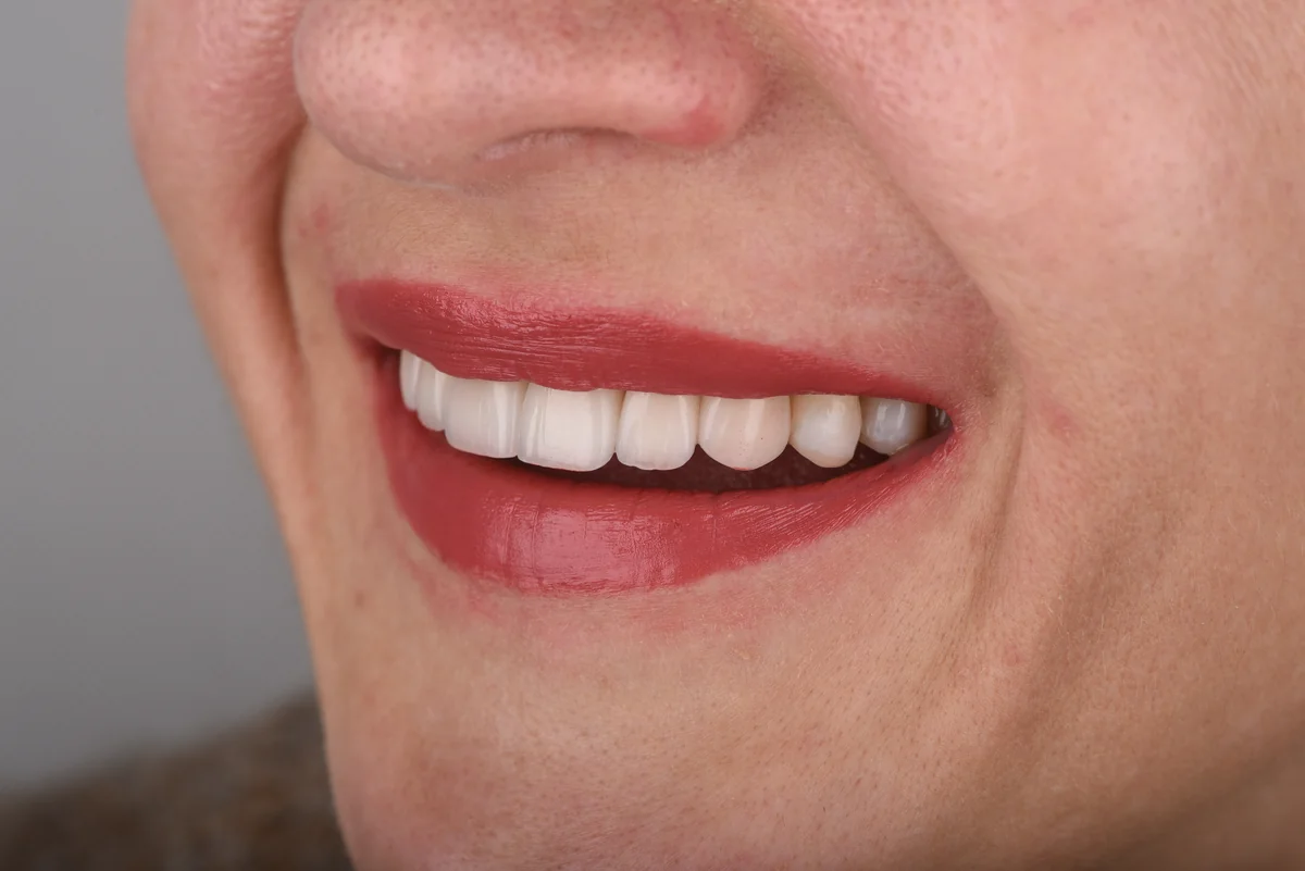 After — Veneers
