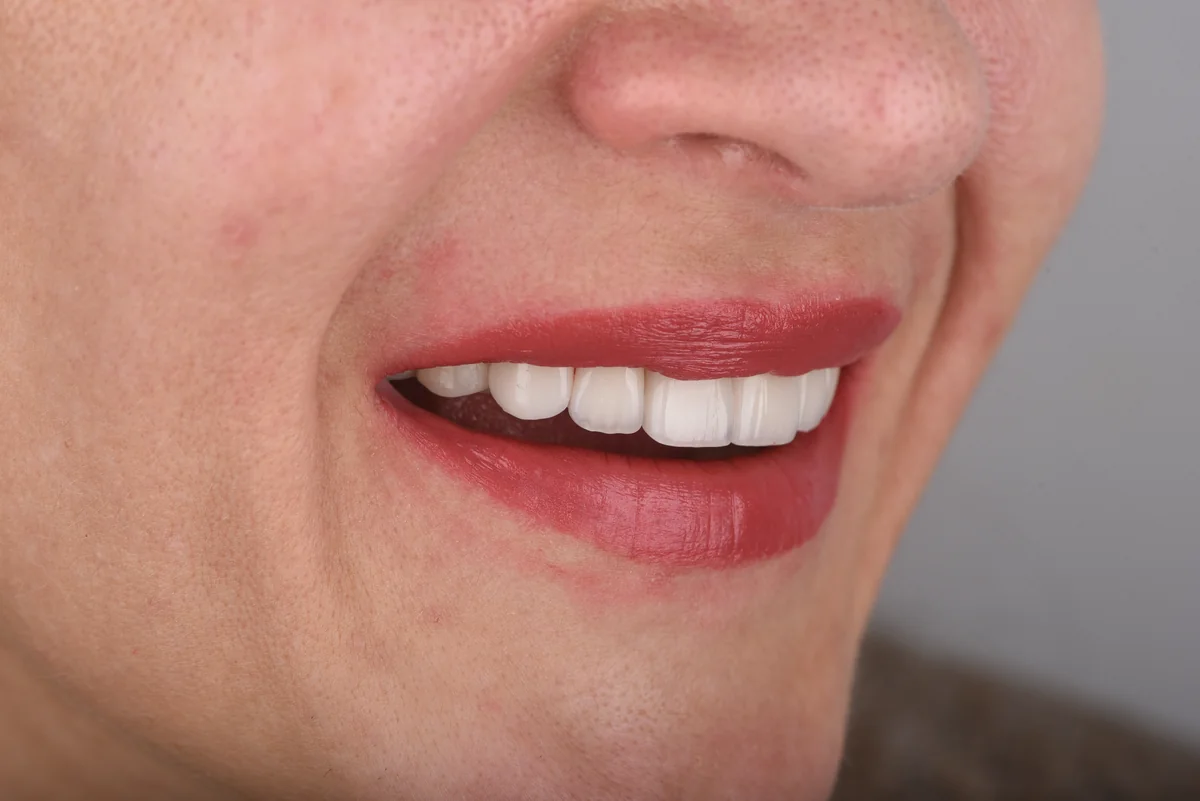 After — Veneers