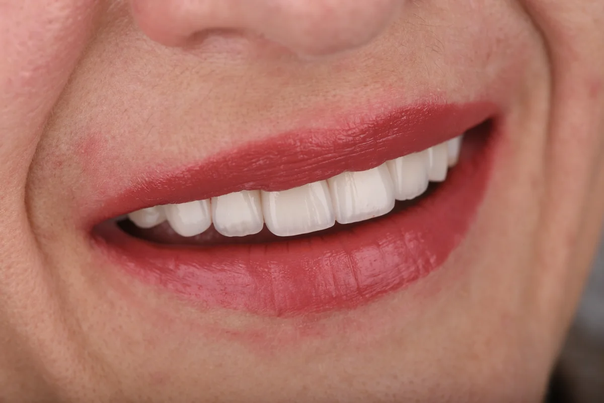 After — Veneers