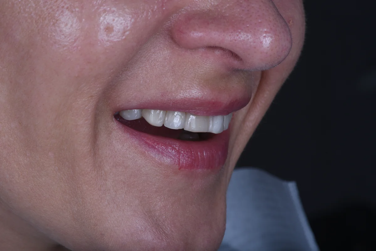 Before — Veneers