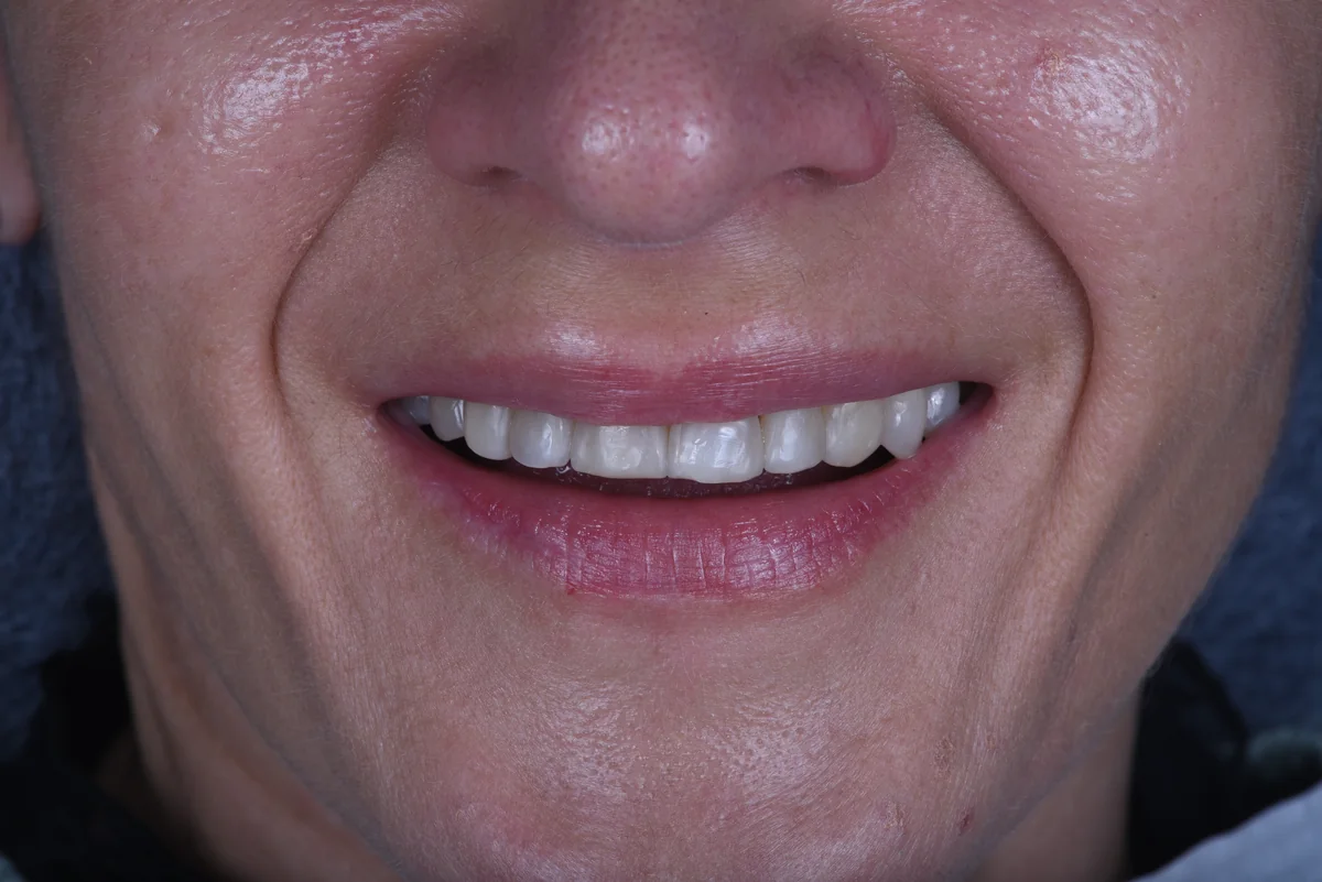 Before — Veneers