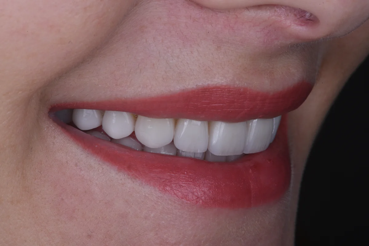 After — Veneers II