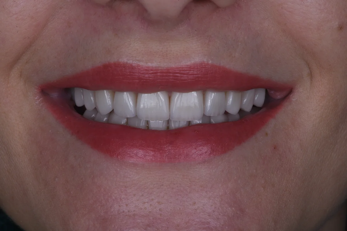 After — Veneers II