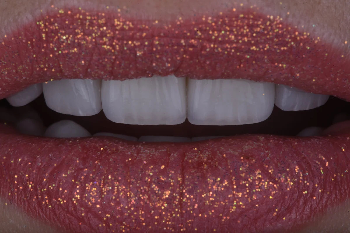Veneers — Veneers II
