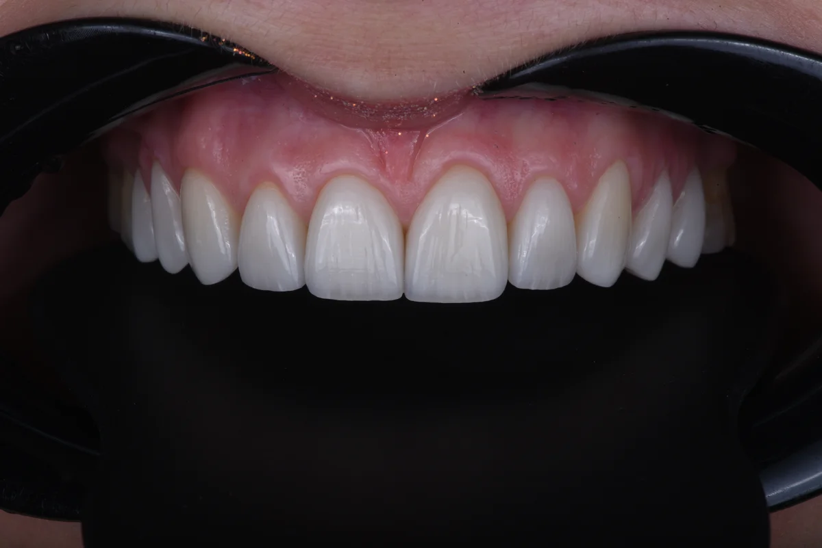 After — Veneers II