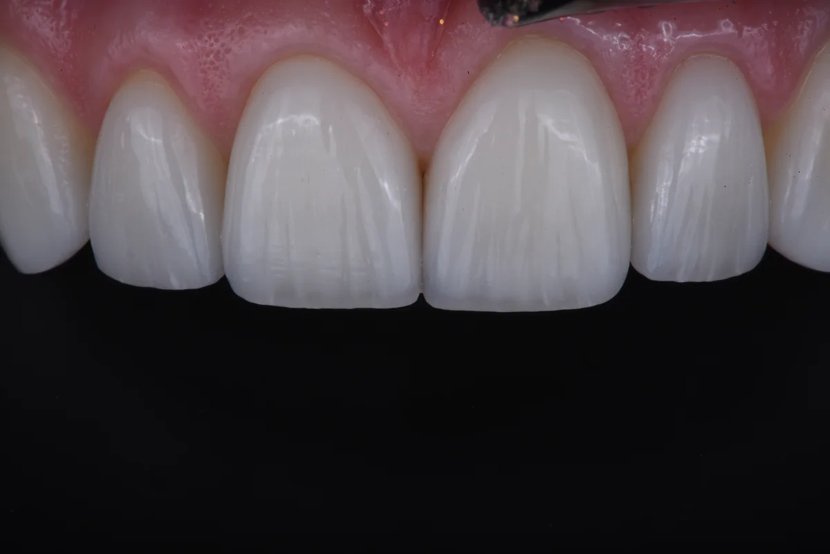 After — Veneers II