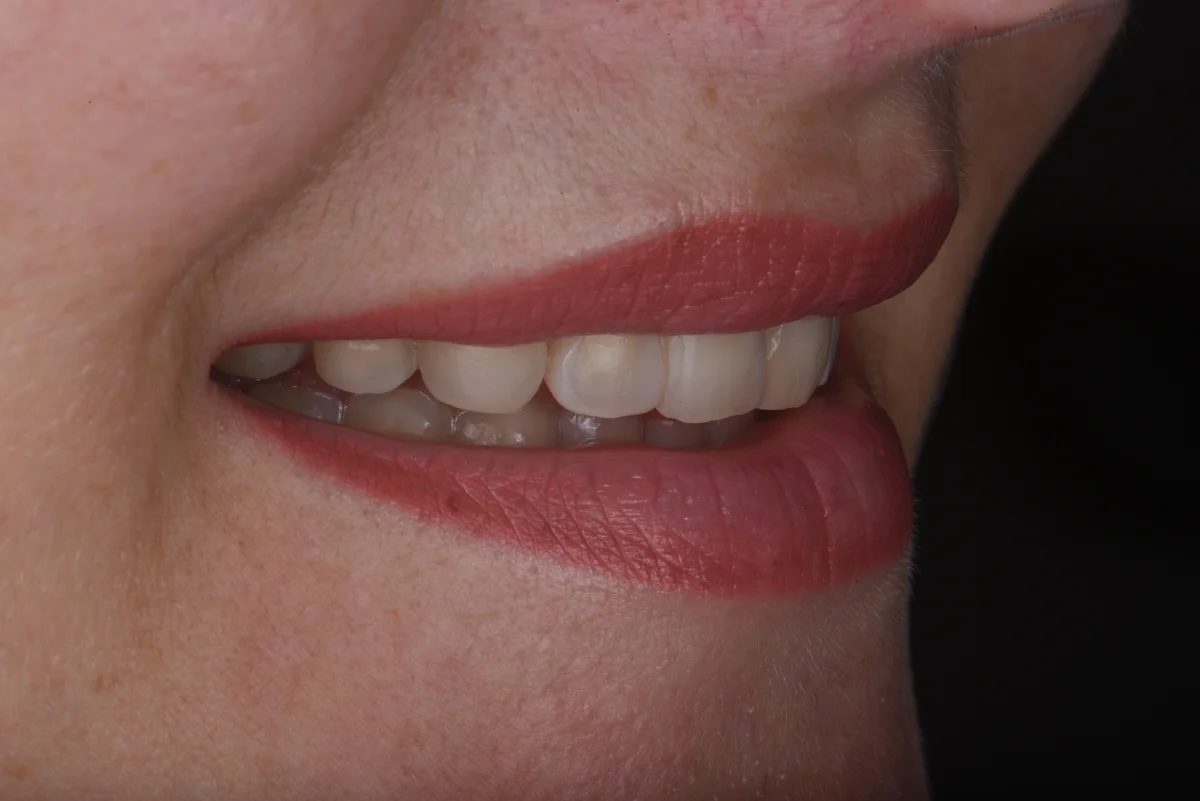 Before — Veneers II