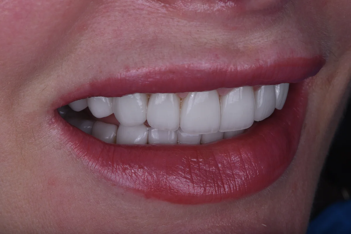 After — Veneers III
