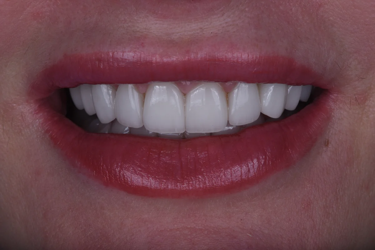 After — Veneers III