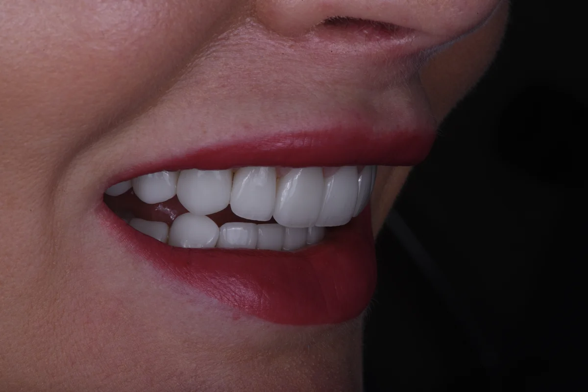Veneers — Veneers III