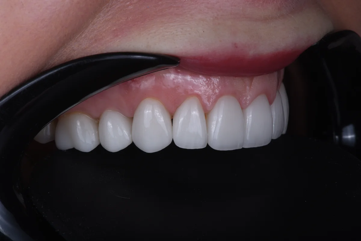 After — Veneers III