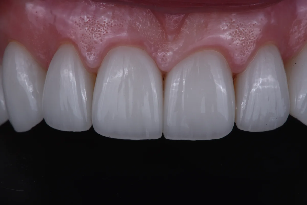 After — Veneers III