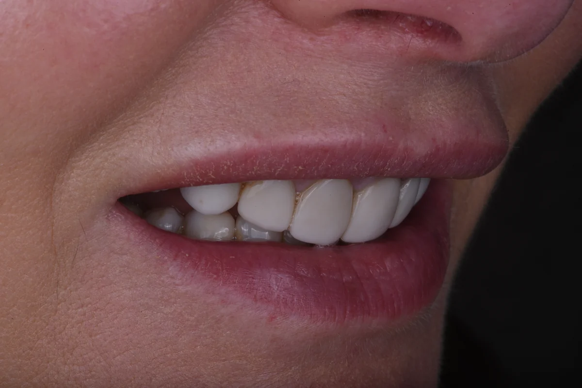 Before — Veneers III